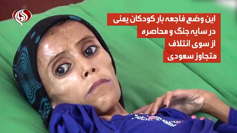انسانیت شرمسار، یمن کی 12 سالہ بچی، 10 کیلو وزن + ویڈیو